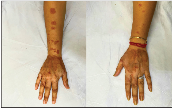 Pre-treatment image of patient 2 showing annular erythematous plaques with central clearing present on bilateral forearms and dorsal of hands.