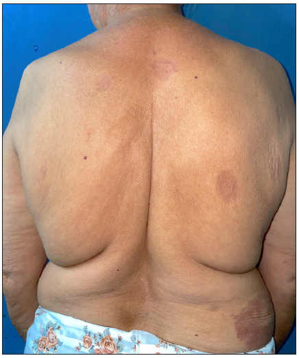 Post-treatment image at 6 months of treatment with tofacitinib showing partial response.