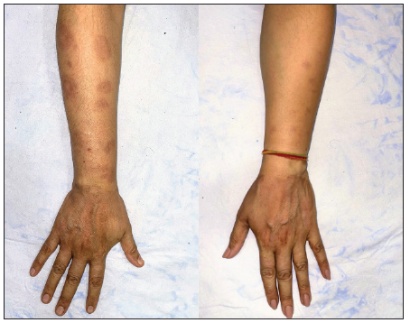 Post-treatment image (at 3 months of therapy with tofacitinib) demonstrating complete clearance of lesions with post inflammatory hyperpigmentation.