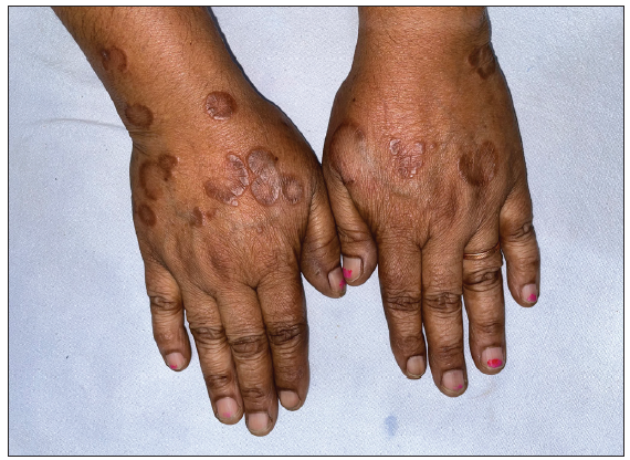 Pre-treatment image of patient 4 showing annular erythematous to brownish papules and plaques with central clearing present on bilateral dorsa of hands.