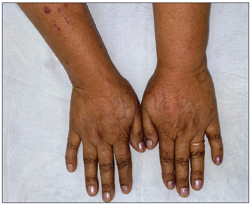 Post-treatment image (at 5 months) showing complete clearance of lesions.