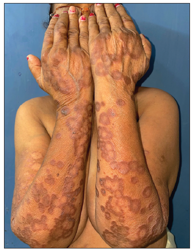 Pre-treatment image of patient 5 showing annular erythematous to brownish plaques with central clearing present on bilateral forearms.