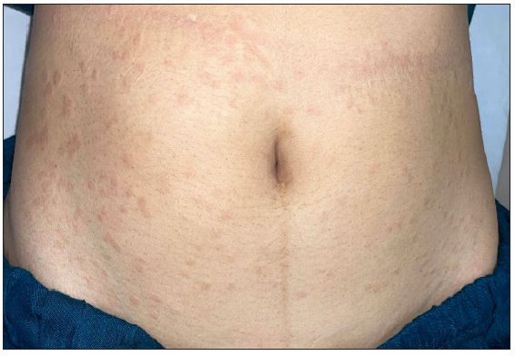 Pre-treatment image of the patient 10 showing annular erythematous papules and plaques with central clearing on the abdomen.