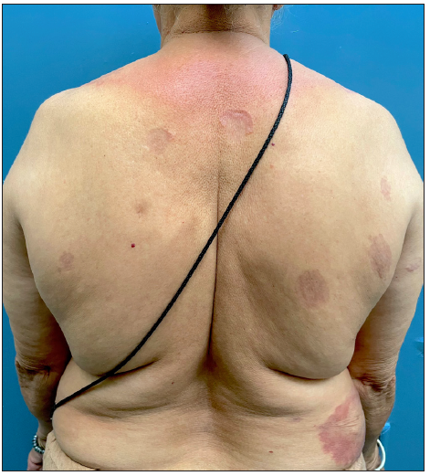 Pre-treatment image of patient 1 showing annular erythematous plaques with central clearing and atrophy on the back.