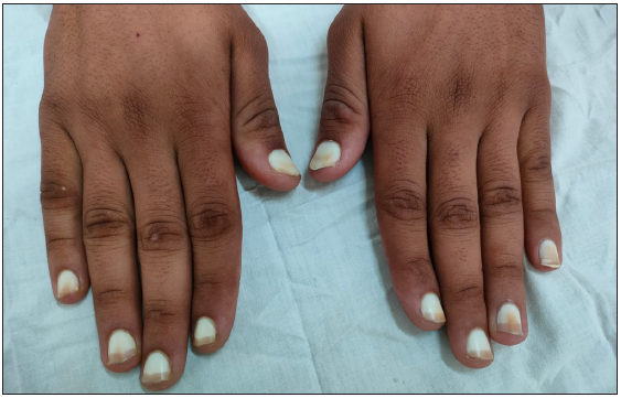 Terry’s nails showing subtotal leukonychia of the proximal nail plate with a narrow (<20%) distal brownish-pinkish band of fingernails.