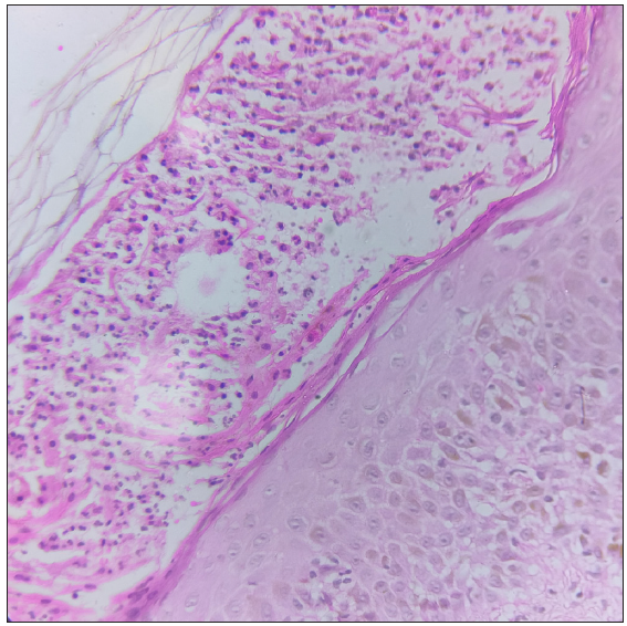 Histopathology showing dermal edema with perivascular mixed inflammatory infiltrate and subcorneal pustule with neutrophils (Haematoxylin and eosin, 400x)