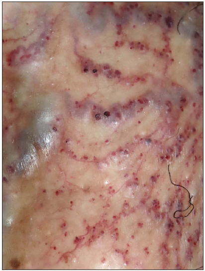 Close-up view of erythematous papules, tortuous dilated veins and telangiectatic vessels on the scrotum.