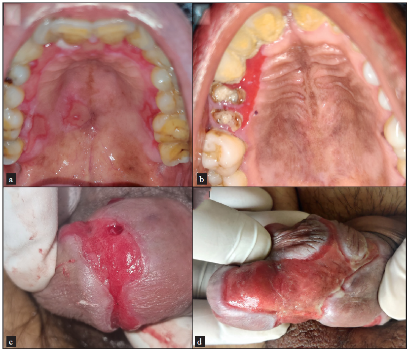 Clinical pictures of mucous membrane pemphigoid patients showing (a) involvement of hard palate, (b) gingival mucosa, and (c and d) penile region with erythematous erosion and lichenoid hue at the periphery.