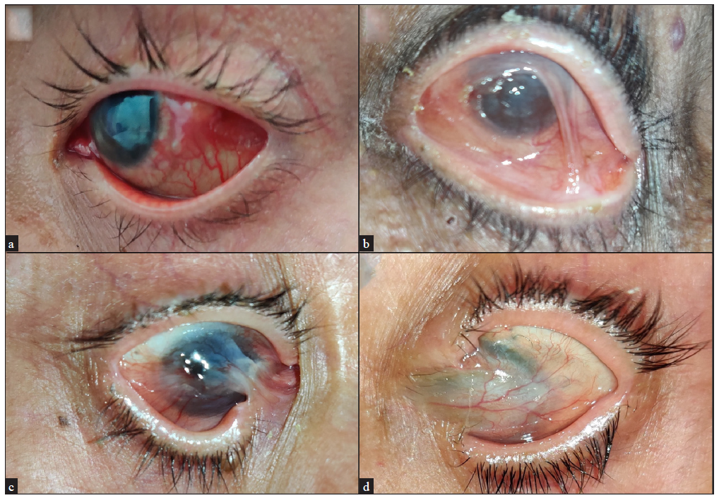 Clinical pictures of ocular mucous membrane pemphigoid patients showing (a) conjunctival congestion, (b) synechiae, (c) symblepharon and shortening of fornices, and (d) corneal clouding