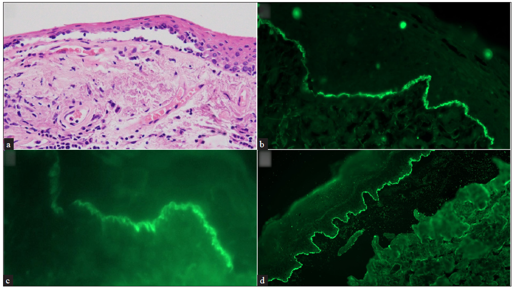 (a) Conjunctival biopsy showing a sub-epithelial cleft. The sub-epithelium showsfibrosis with lymphomononuclear infiltrate (hematoxylin and eosin, 200x), (b) Direct immunofluorescence (DIF) showing strong linear IgG deposits along the epithelial basement membrane zone (Fluorescein isothiocyanate, 400x), (c) High power of DIF showing “n” serration pattern (Fluorescein isothiocyanate, 630x), and (d) salt split skin indirect immunofluorescence showing roof pattern binding for IgG (Fluorescein isothiocyanate, 200x)