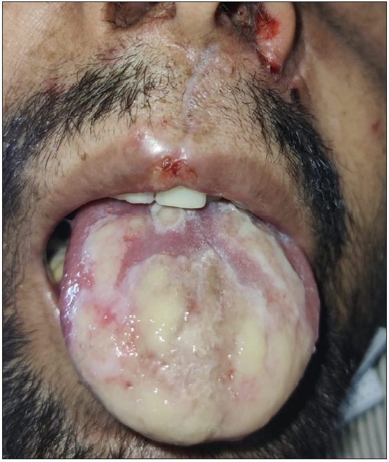Large geographic ulcer in oral cavity.