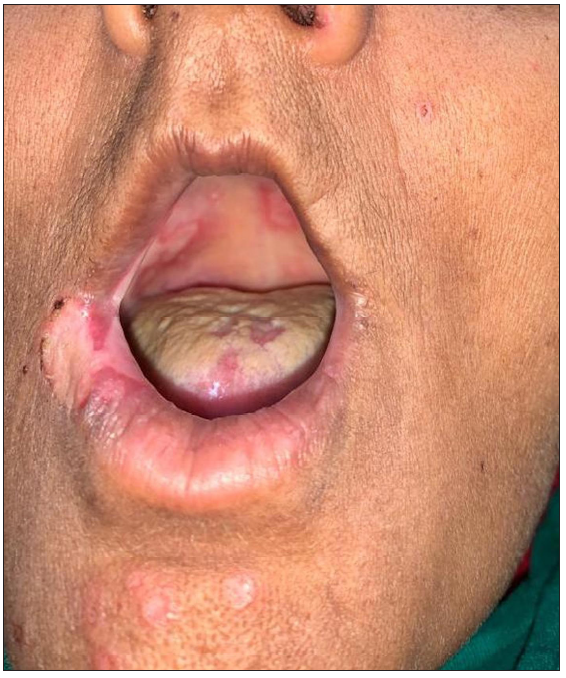 Polycyclic erosion in the oral cavity with annular erosions on the chin.