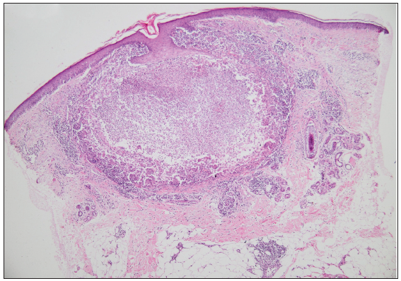 Histopathology shows thinned-out epidermis. Dermis shows a large area of necrosis surrounded by palisading epitheloid cells and giant cells (Haematoxylin and eosin; 40x).