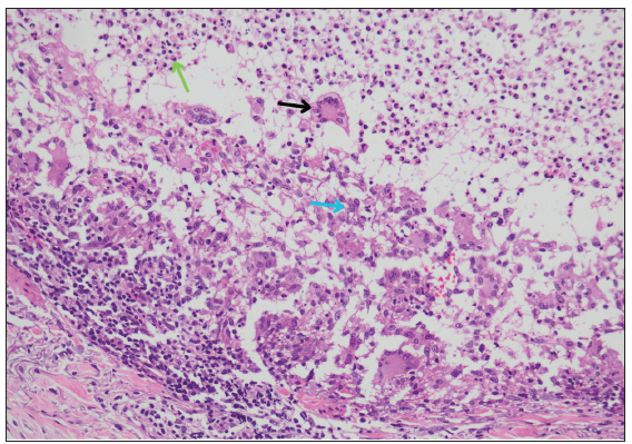 Higher power view shows necrotic tissue containing a collection of neutrophils (green arrow) and surrounded by palisading epitheloid cells (blue arrow) and giant cells (black arrow) (Haematoxylin and eosin; 200x).