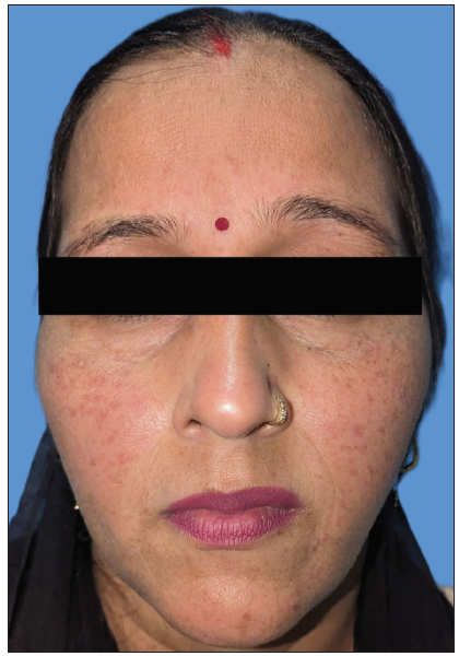 Post-treatment image after 3-months showing flattening of lesions without scarring.