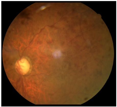 Fundus left eye showing a dilated tortuous vessel with extensive superficial retinal haemorrhage in the superior half of the retina.