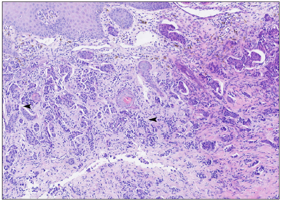 Histopathology demonstrates invasive ductal carcinoma (black arrowheads) in the dermis (Haematoxylin and Eosin, 100x).