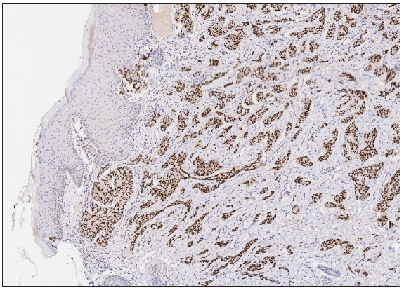 Tumour cells were positive for Estrogen Receptor (ER) (Immunohistochemistry, 100x).