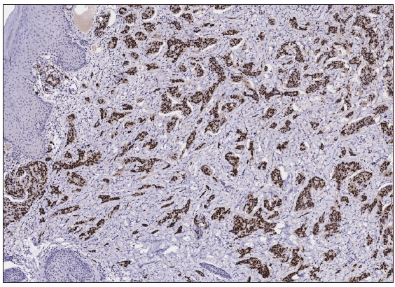 Tumour cells were positive for Progesterone Receptor (PR) (Immunohistochemistry, 100x).