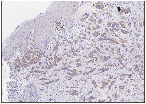 The expression of Human Epidermal Growth Factor Receptor 2 (HER2) was 2+ (Immunohistochemistry, 100x).