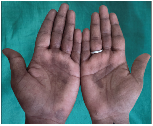 Patchy hyperpigmentation on both the palms.