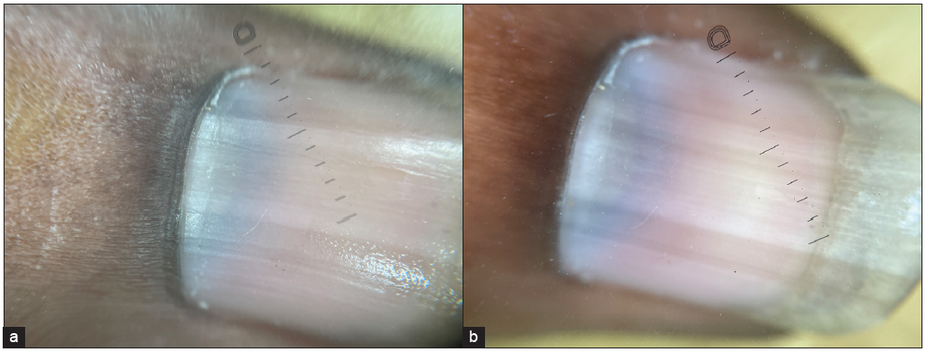 Bluish hue on the lunula of the thumbnail 10x, dermlite Dl5. (a) Non-polarised mode, (b) Polarised mode.