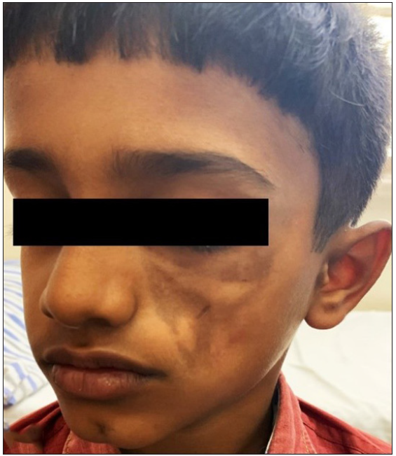 Plaque-type morphea affecting the face in a child.