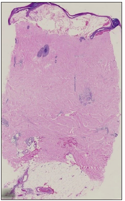 Full-thickness sclerosis, ‘square biopsy’ sign and ‘line’ sign. (Haematoxylin and eosin, 10x)