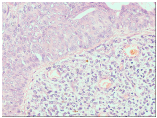 Small uniform cuboidal cells with a central basophilic nucleus and pale eosinophilic cytoplasm, arranged as micro follicles and differentiated from normal keratinocytes (Haematoxylin and eosin, 40x).