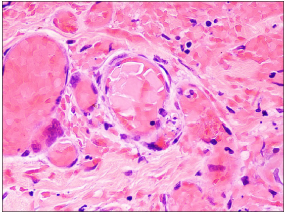 Punch biopsy of the skin showing oblong, crystalline eosinophilic pink deposits occluding the blood vessels in the superficial and deep dermis (haematoxylin and eosin, 400×).