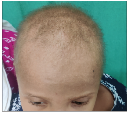 Hypopigmented, sparse hair over the scalp.