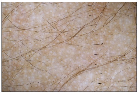 Dermoscopic image of the scalp showed pigment dilution and thinning of hair (Dermlite DL4 10x, polarised mode).