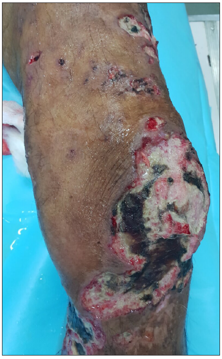 Multiple ulcers over the left lower limb extending from mid-thigh to ankle with intervening areas of intact, atrophic skin.