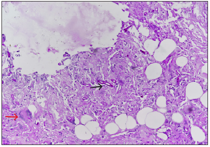On histopathology, dermis, and subcutaneous tissue showed numerous foreign body types of giant cells (red arrow) along with moderate to dense mixed inflammatory cell infiltrate and broad, aseptate fungal hyphae (black arrow). (Haematoxylin and Eosin; 400x).
