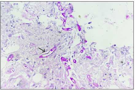 Positive Periodic acid-Schiff stain conforming to the morphology of mucormycosis (black arrow). (Periodic acid schiff; 40x).