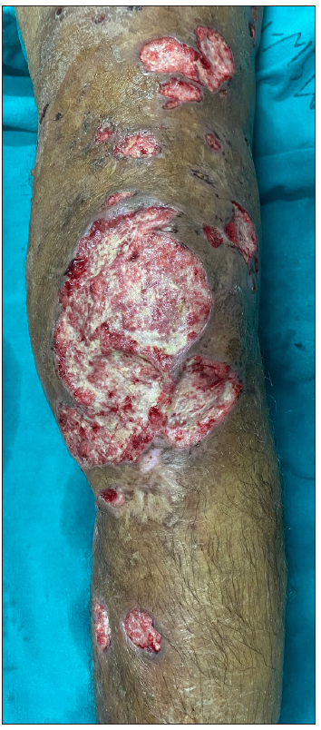Healing ulcers with red granulation tissue at the base and sloping margins at 4 weeks.