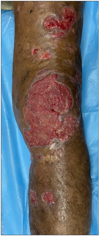 Healing ulcers with red granulation tissue at the base and sloping margins at 8 weeks.