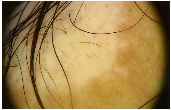 Dermoscopy under polarised light (10×) of the clinically spared area displaying black dots, broken hairs, and perifollicular pigmentation.