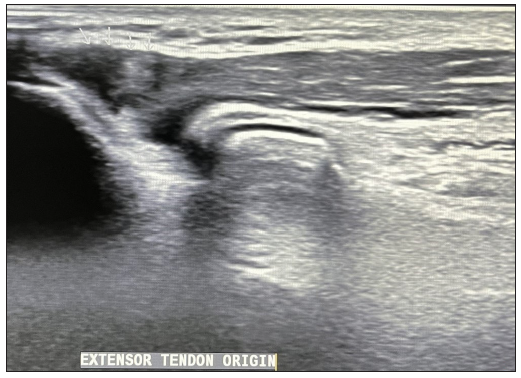 Longitudinal ultrasound image at the normal extensor tendon at elbow.