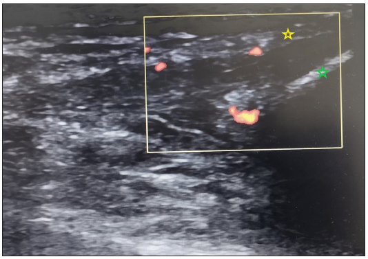 Longitudinal ultrasound image at the elbow joint (marked by yellow square) shows affliction of the common extensor tendon with loss of fibrillary pattern and increased doppler signals (Green star – lateral epicondyle; yellow star – tendon).