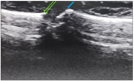 Longitudinal ultrasound image at the distal interphalangeal joint showing erosions affecting the articular surface, bone loss and irregularity (Green arrow – middle phalynx distal end; blue arrow – base of the distal phalynx).