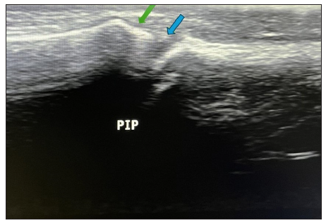 Longitudinal ultrasound image at the normal proximal interphalangeal joint (Green arrow – middle phalynx distal end; blue arrow – base of the distal phalynx).