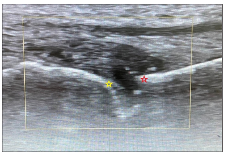 Longitudinal ultrasound image through a proximal interphalangeal joint (marked by yellow square) showing characteristic synovial thickening (yellow star – head of the proximal phalynx; red star – base of the middle phalynx).