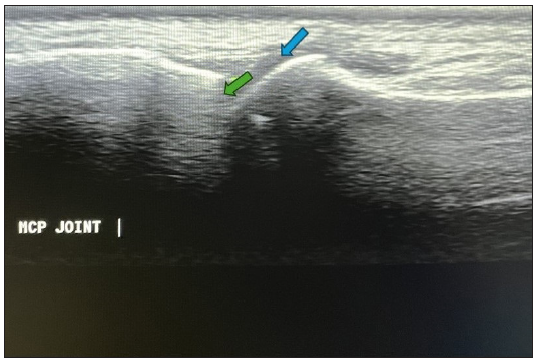 Longitudinal ultrasound image at the normal metacarpophalangeal joint (Green arrow – metacarpal head; blue arrow – base of the phalanx).