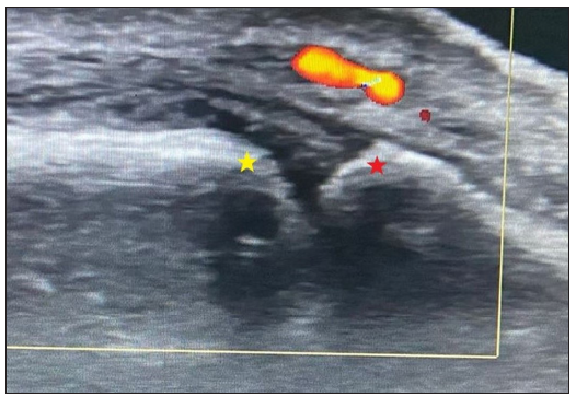 Longitudinal ultrasound image through an affected metacarpophalangeal joint (marked by yellow square) showing synovial thickening with increased doppler signals (yellow star – metacarpal head; red star – base of the phalanx).