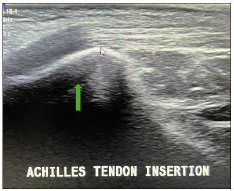 Longitudinal ultrasound image at the insertion of the normal tendo-achilles (marked by green arrow).