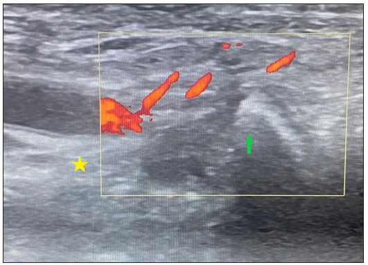 Longitudinal ultrasound image at the insertion site of the affected tendo-achilles (marked by yellow square). The image shows thickening and complete loss of the fibrillary pattern of the tendon. Increased doppler signal is seen along the tendon and the peritendinous tissue (yellow star – calcaneum; green arrow – tendo-achilles).