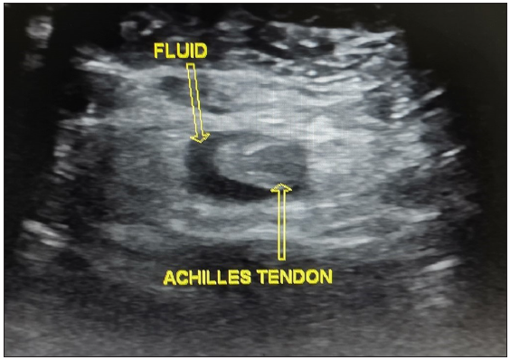 Axial image through the tendon (marked by upward yellow arrow) shows fluid around the tendon (marked by downward yellow arrow).