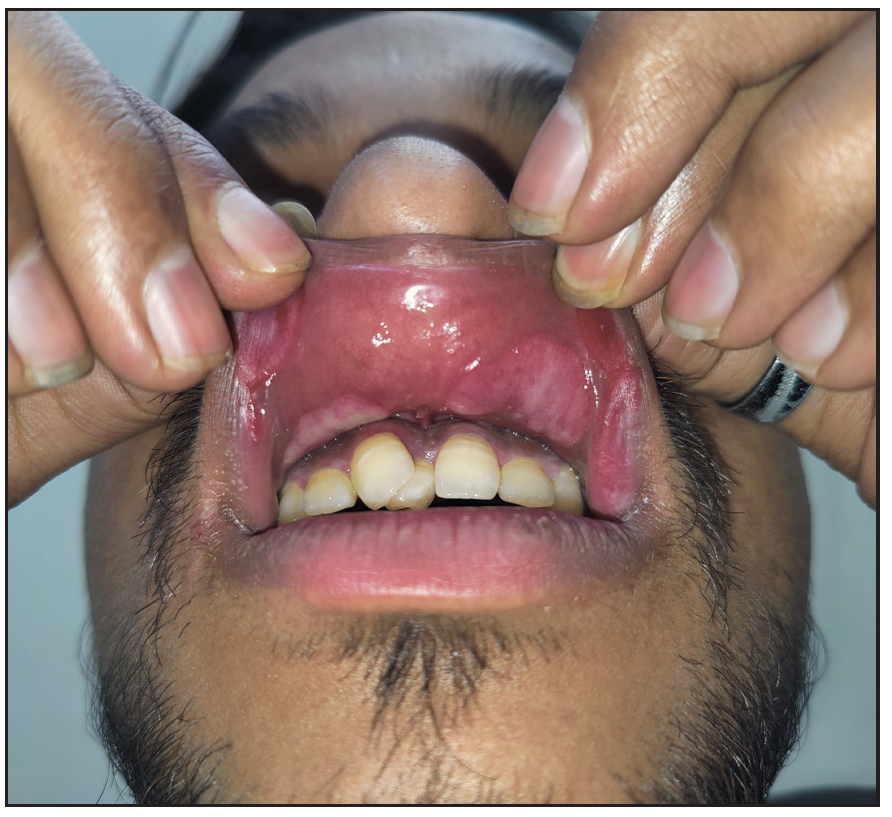 Mucous patches in a patient with secondary syphilis.