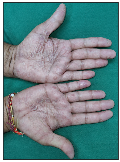 Multiple well-defined erythematous to brown papulosquamous plaques with Biett collarette over the palms and soles in a patient with secondary syphilis.